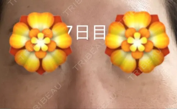 下まぶたの脂肪取り あじまビューティークリニック DAY 7 メイン用