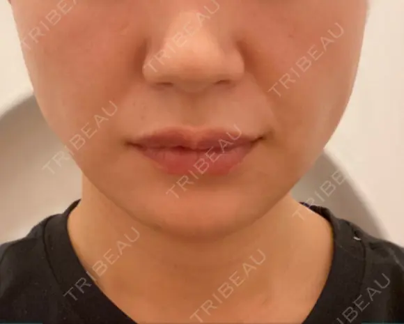 糸リフト / ヒアルロン酸注入（あご） ブルームクリニック（BLOOM CLINIC） DAY 4 メイン用