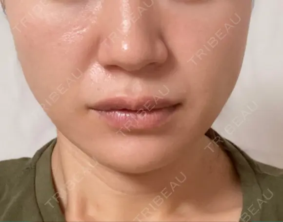 糸リフト / ヒアルロン酸注入（あご） ブルームクリニック（BLOOM CLINIC） DAY 6 メイン用
