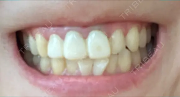 セラミック / ラミネートベニア / その他（口元） 東京銀座A CLINIC デンタル DAY 31 メイン用