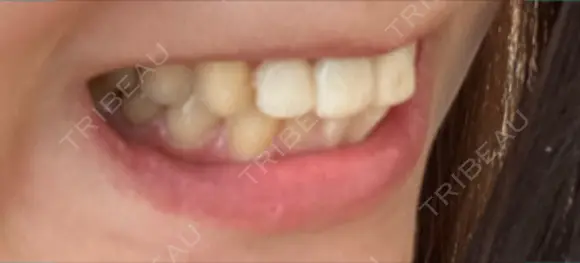 セラミック / ラミネートベニア / その他（口元） 東京銀座A CLINIC デンタル DAY 31 メイン用