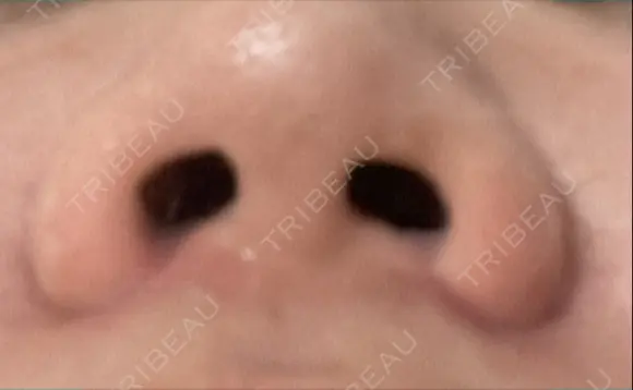 小鼻縮小（切開） くさのたろうクリニック DAY 15 メイン用