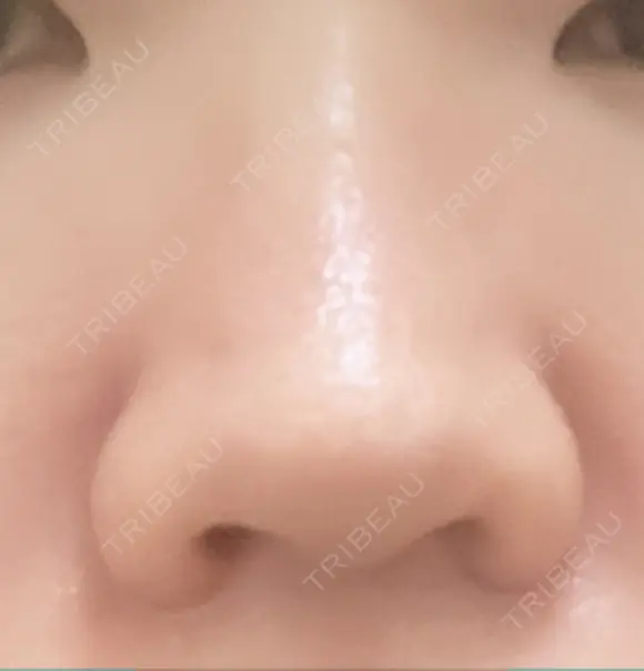 小鼻縮小（切開） くさのたろうクリニック DAY 19 メイン用