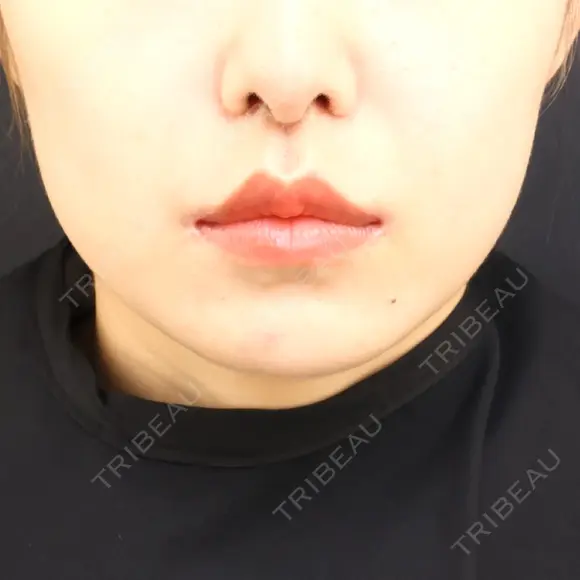 小鼻縮小（切開） / 人中短縮 / 鼻翼挙上 / 口角挙上 Otus Clinic 【オータスクリニック】 AFTER メイン用