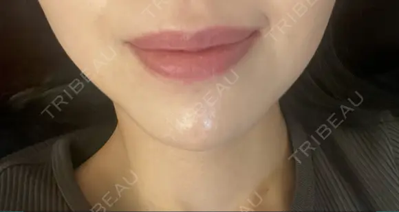 ヒアルロン酸注入（あご） ルラ美容クリニック 名古屋本院 DAY 5 メイン用