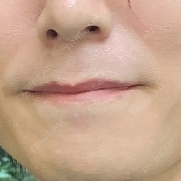 医療脱毛（顔） お茶の水美容形成クリニック AFTER メイン用