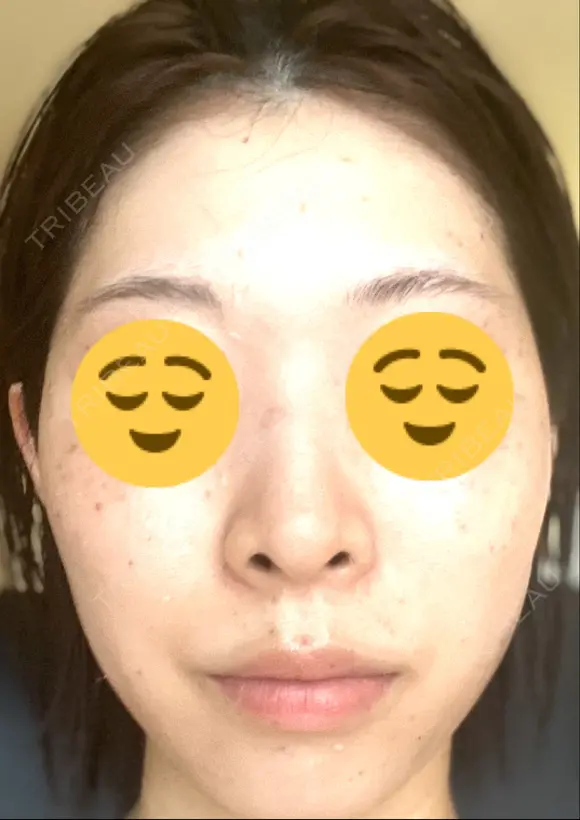 シミ取りレーザー Mavie Beauty Clinic （マヴィービューティークリニック） DAY 3 メイン用