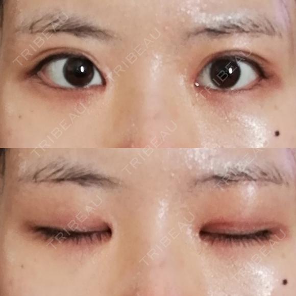 目頭切開 / 目尻切開 / 水光注射（ハリ・美肌） エートップ美容整形外科 DAY 21 メイン用