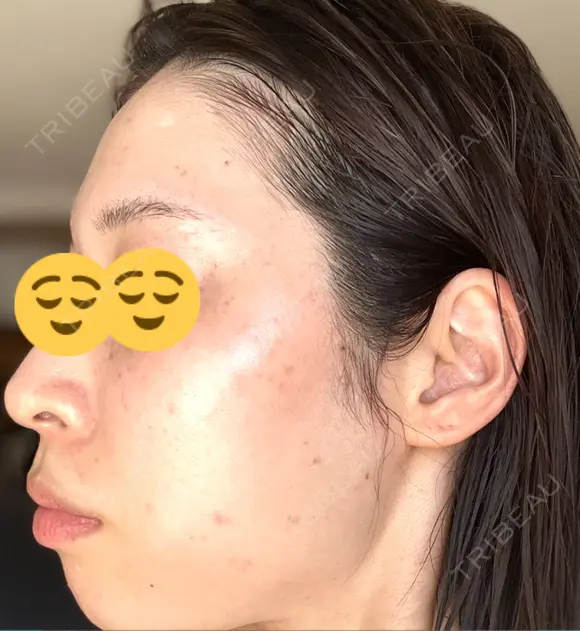 シミ取りレーザー Mavie Beauty Clinic （マヴィービューティークリニック） DAY 4 メイン用