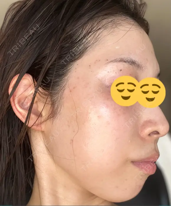 シミ取りレーザー Mavie Beauty Clinic （マヴィービューティークリニック） DAY 4 メイン用