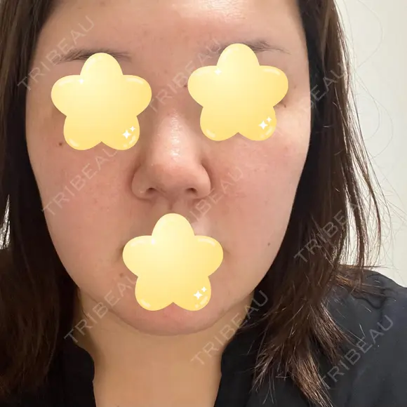 隆鼻術 / 鼻尖形成（切開） / 軟骨移植 エースクリニック 名古屋院 DAY 7 メイン用