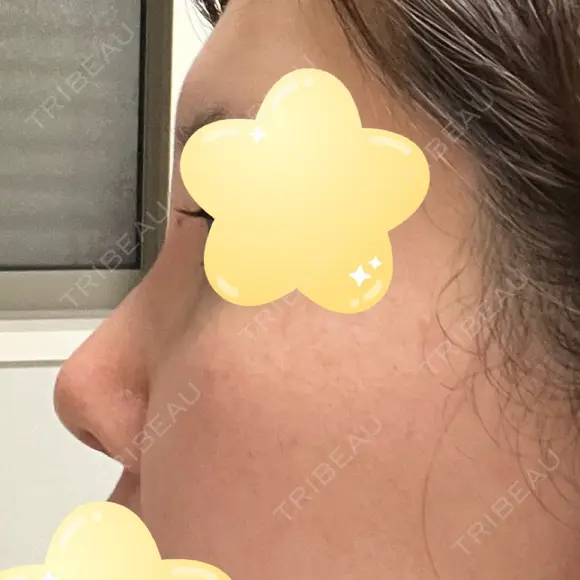 隆鼻術 / 鼻尖形成（切開） / 軟骨移植 エースクリニック 名古屋院 DAY 7 メイン用