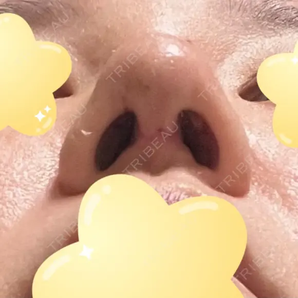 隆鼻術 / 鼻尖形成（切開） / 軟骨移植 エースクリニック 名古屋院 DAY 7 メイン用