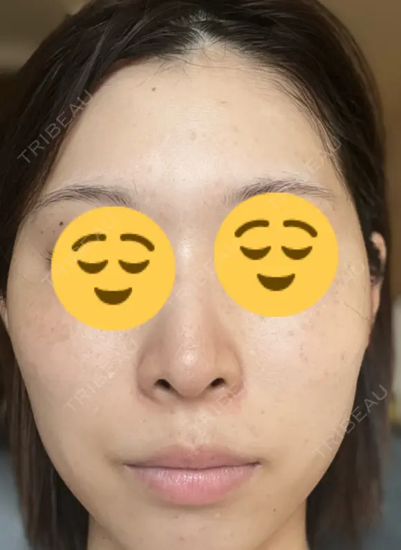 シミ取りレーザー Mavie Beauty Clinic （マヴィービューティークリニック） AFTER メイン用