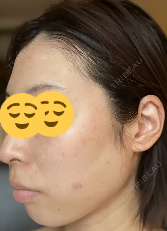 シミ取りレーザー Mavie Beauty Clinic （マヴィービューティークリニック） DAY 5 メイン用