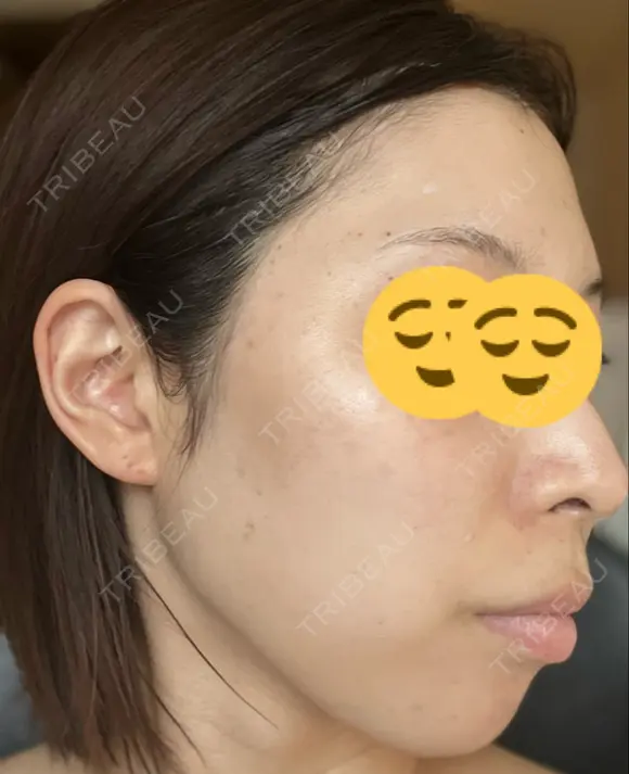 シミ取りレーザー Mavie Beauty Clinic （マヴィービューティークリニック） DAY 5 メイン用