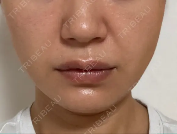 糸リフト / ヒアルロン酸注入（あご） ブルームクリニック（BLOOM CLINIC） DAY 17 メイン用
