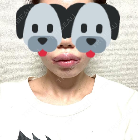 脂肪吸引（顔） / 口唇縮小術 / 口角挙上 / ジョールファット除去 / ヒアルロン酸注入（あご） / ボトックス（エラ・小顔） / ボトックス（口角） Otus Clinic 【オータスクリニック】 DAY 26 メイン用