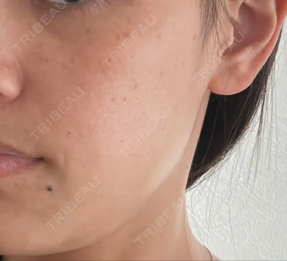 ほくろ・いぼ切除（肌） 心斎橋形成外科スキンケアクリニック AFTER メイン用