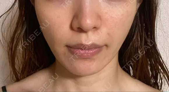 糸リフト / 脂肪吸引注射（顔） 湘南美容クリニック 名古屋栄院 DAY 63 メイン用