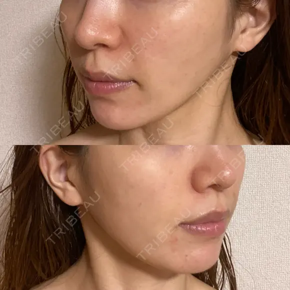 糸リフト / 脂肪吸引注射（顔） 湘南美容クリニック 名古屋栄院 DAY 63 メイン用