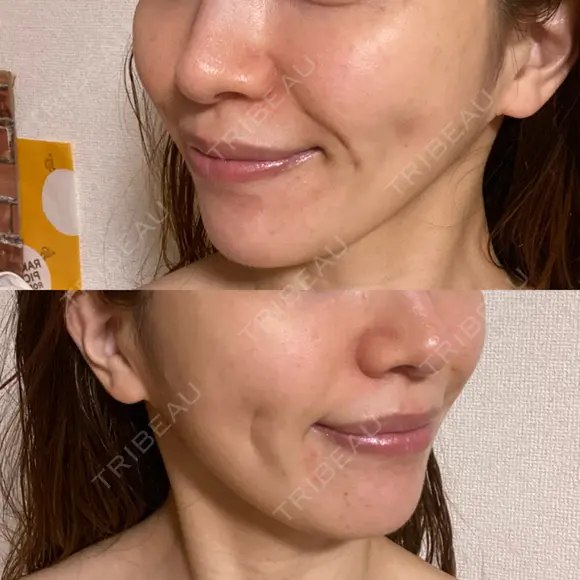 糸リフト / 脂肪吸引注射（顔） 湘南美容クリニック 名古屋栄院 DAY 63 メイン用