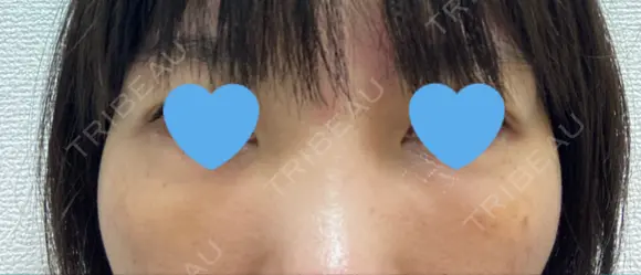 クマ治療 / 下まぶたたるみ取り / 下まぶたの脂肪取り / 脂肪注入（目の下） お茶の水美容形成クリニック DAY 10 メイン用