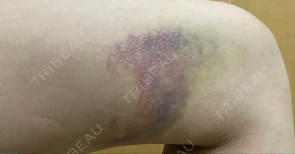 クマ治療 / 下まぶたたるみ取り / 下まぶたの脂肪取り / 脂肪注入（目の下） お茶の水美容形成クリニック DAY 10 メイン用