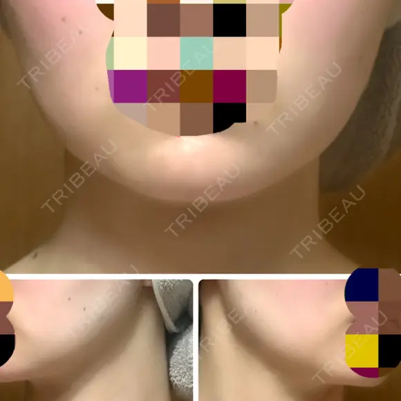 ボトックス（エラ・小顔） TCB東京中央美容外科 大宮東口院 AFTER メイン用