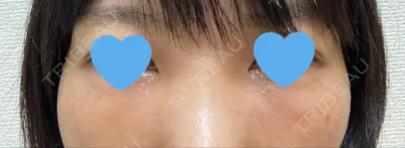 クマ治療 / 下まぶたたるみ取り / 下まぶたの脂肪取り / 脂肪注入（目の下） お茶の水美容形成クリニック DAY 11 メイン用