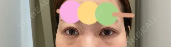 二重埋没 / 眼瞼下垂（非切開） BRIGHTS beauty clinic DAY 0 メイン用