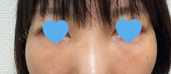 クマ治療 / 下まぶたたるみ取り / 下まぶたの脂肪取り / 脂肪注入（目の下） お茶の水美容形成クリニック DAY 12 メイン用