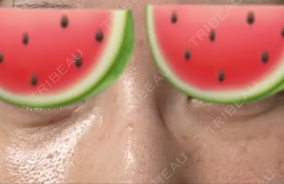 下まぶたの脂肪取り あじまビューティークリニック AFTER メイン用