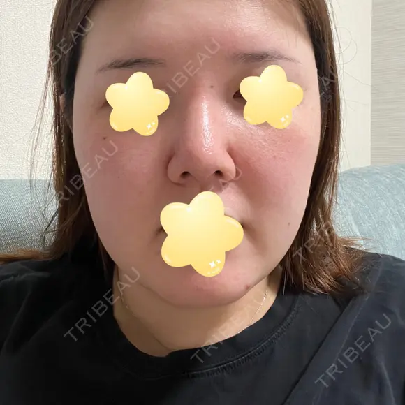 隆鼻術 / 鼻尖形成（切開） / 軟骨移植 エースクリニック 名古屋院 DAY 14 メイン用