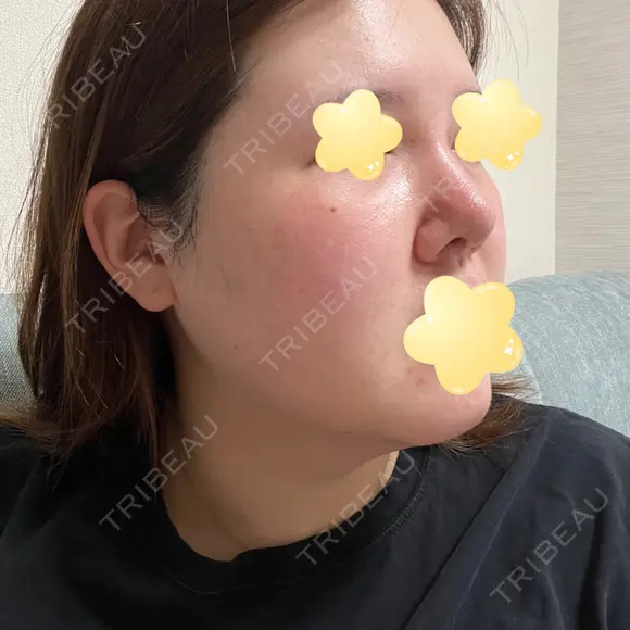 隆鼻術 / 鼻尖形成（切開） / 軟骨移植 エースクリニック 名古屋院 DAY 14 メイン用