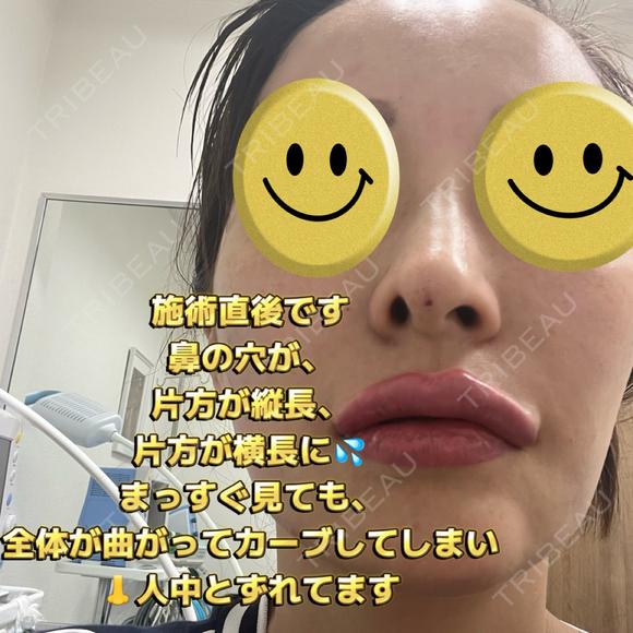 その他（鼻） / 鼻尖縮小 / 肌ヒアルロン酸注入（たるみ・シワ改善） / ヒアルロン酸注入（唇） / シワ取りボトックス / ヒアルロン酸注入（ほうれい線） 東京形成美容外科 船橋院 DAY 0 メイン用
