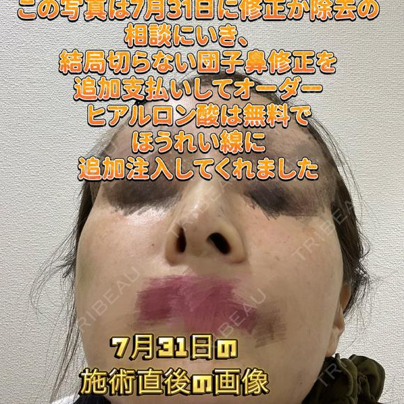 その他（鼻） / 鼻尖縮小 / 肌ヒアルロン酸注入（たるみ・シワ改善） / ヒアルロン酸注入（唇） / シワ取りボトックス / ヒアルロン酸注入（ほうれい線） 東京形成美容外科 船橋院 DAY 0 メイン用
