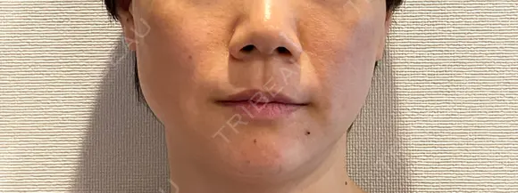 糸リフト 東郷美容形成外科　福岡 DAY 1 メイン用