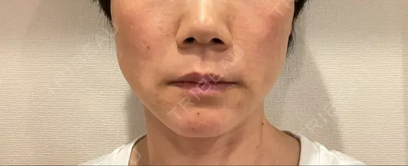 糸リフト 東郷美容形成外科　福岡 DAY 3 メイン用