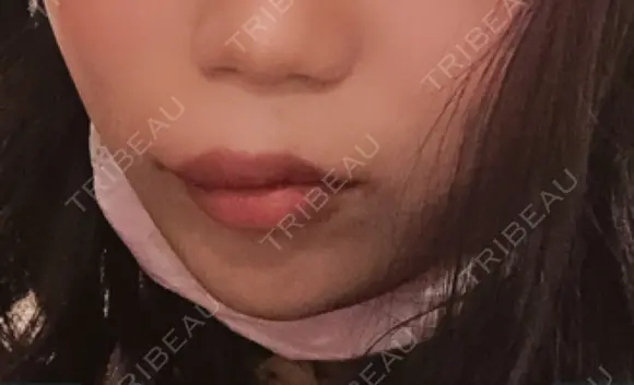 ヒアルロン酸注入（あご） / ボトックス（エラ・小顔） / ヒアルロン酸注入（唇） TCB東京中央美容外科 郡山院 DAY 3 メイン用