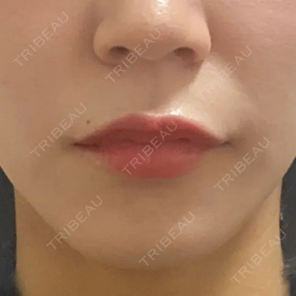 ボトックス（あご） / ボトックス（口角） / ボトックス（肩） / ボトックス（人中） EMMO FACE CLINIC 大宮院 DAY 1 メイン用