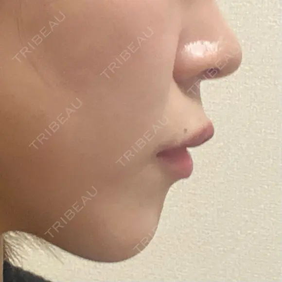 ボトックス（あご） / ボトックス（口角） / ボトックス（肩） / ボトックス（人中） EMMO FACE CLINIC 大宮院 DAY 1 メイン用