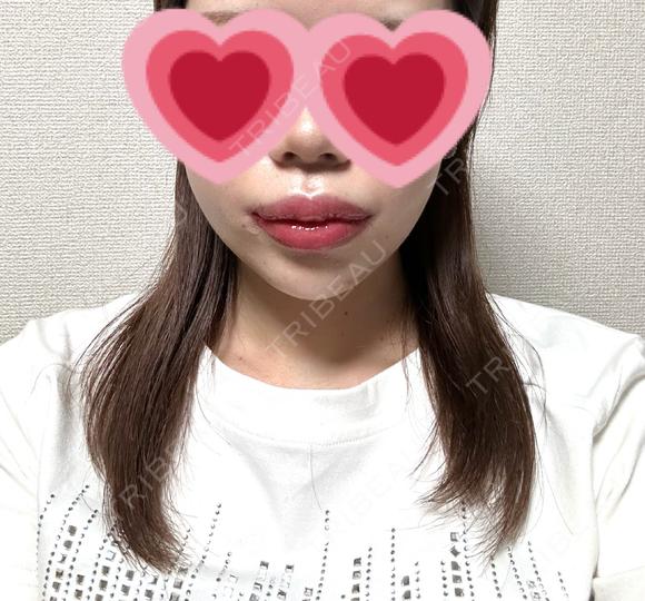 脂肪吸引（顔） / 口唇縮小術 / 口角挙上 / ジョールファット除去 / ヒアルロン酸注入（あご） / ボトックス（エラ・小顔） / ボトックス（口角） Otus Clinic 【オータスクリニック】 AFTER メイン用
