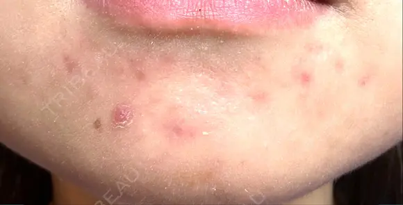 その他（肌） / ニードルRF（ポテンツァなど） KM新宿クリニック DAY 26 メイン用