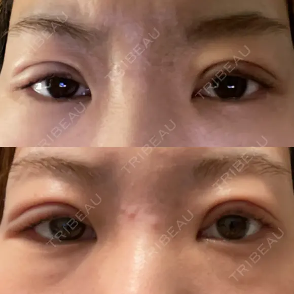 二重埋没 / 眼瞼下垂（非切開） BRIGHTS beauty clinic DAY 1 メイン用