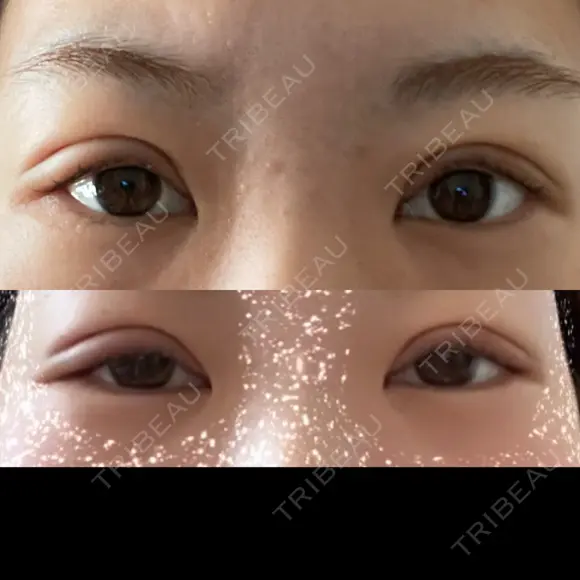 二重埋没 / 眼瞼下垂（非切開） BRIGHTS beauty clinic DAY 2 メイン用