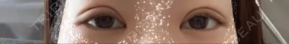 二重埋没 / 眼瞼下垂（非切開） BRIGHTS beauty clinic DAY 3 メイン用
