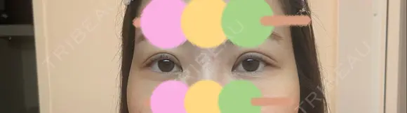 二重埋没 / 眼瞼下垂（非切開） BRIGHTS beauty clinic DAY 4 メイン用