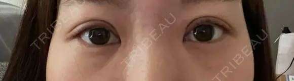 二重埋没 / 眼瞼下垂（非切開） BRIGHTS beauty clinic DAY 5 メイン用