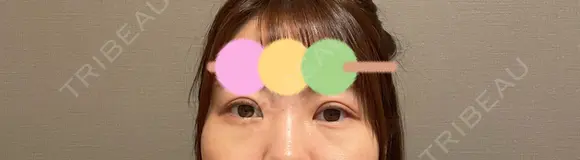 二重埋没 / 眼瞼下垂（非切開） BRIGHTS beauty clinic DAY 11 メイン用